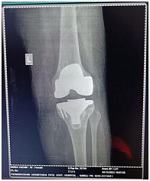 POST OP
